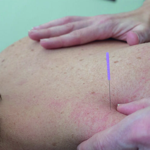 Dry Needling